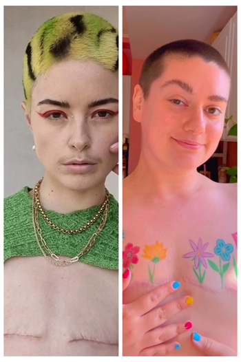 "Non-binary" women who got top surgery